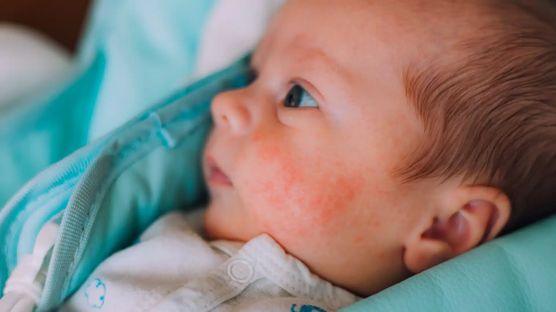 Milk Allergy in Babies: Best Formula Options for Safe Feeding